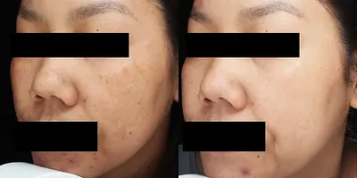 ROHTO AOHAL CLINICが提供する肌再生のPRFメソセラピー。年齢にとらわれないお肌へ