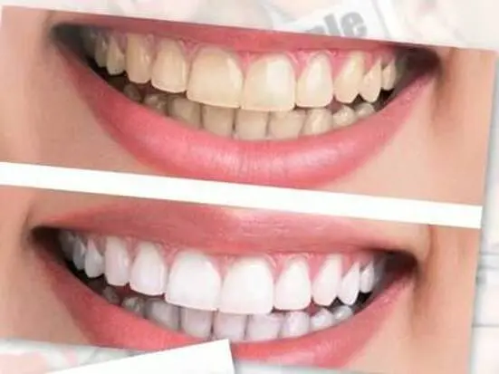 美しい歯を取り戻してみませんか？