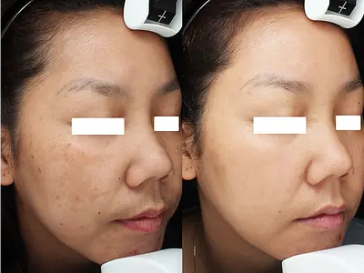 ロートアオハルクリニック ベトナム PRF Treatment