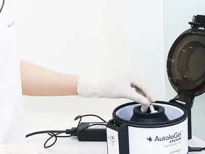 PRF Treatment