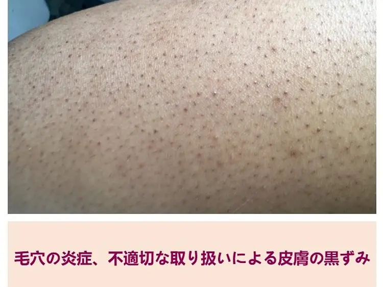 サファイア脱毛