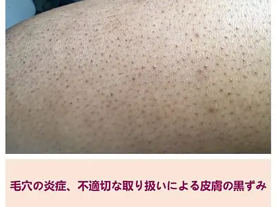 サファイア脱毛