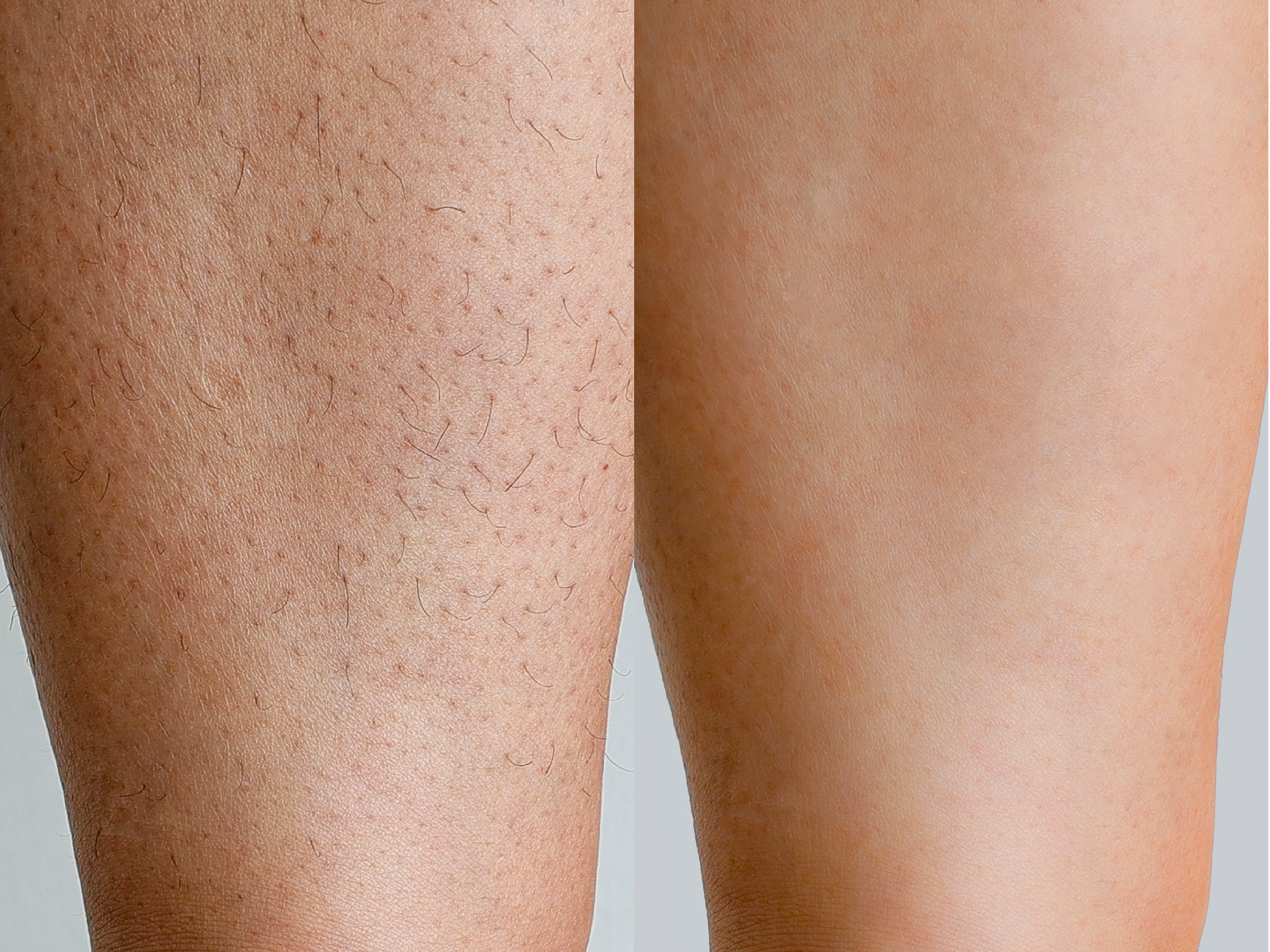 サファイア脱毛