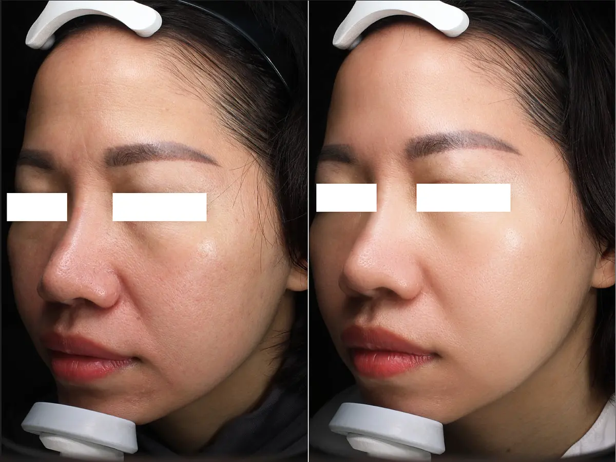  冬の乾燥対策におすすめの正しいスキンケア方法